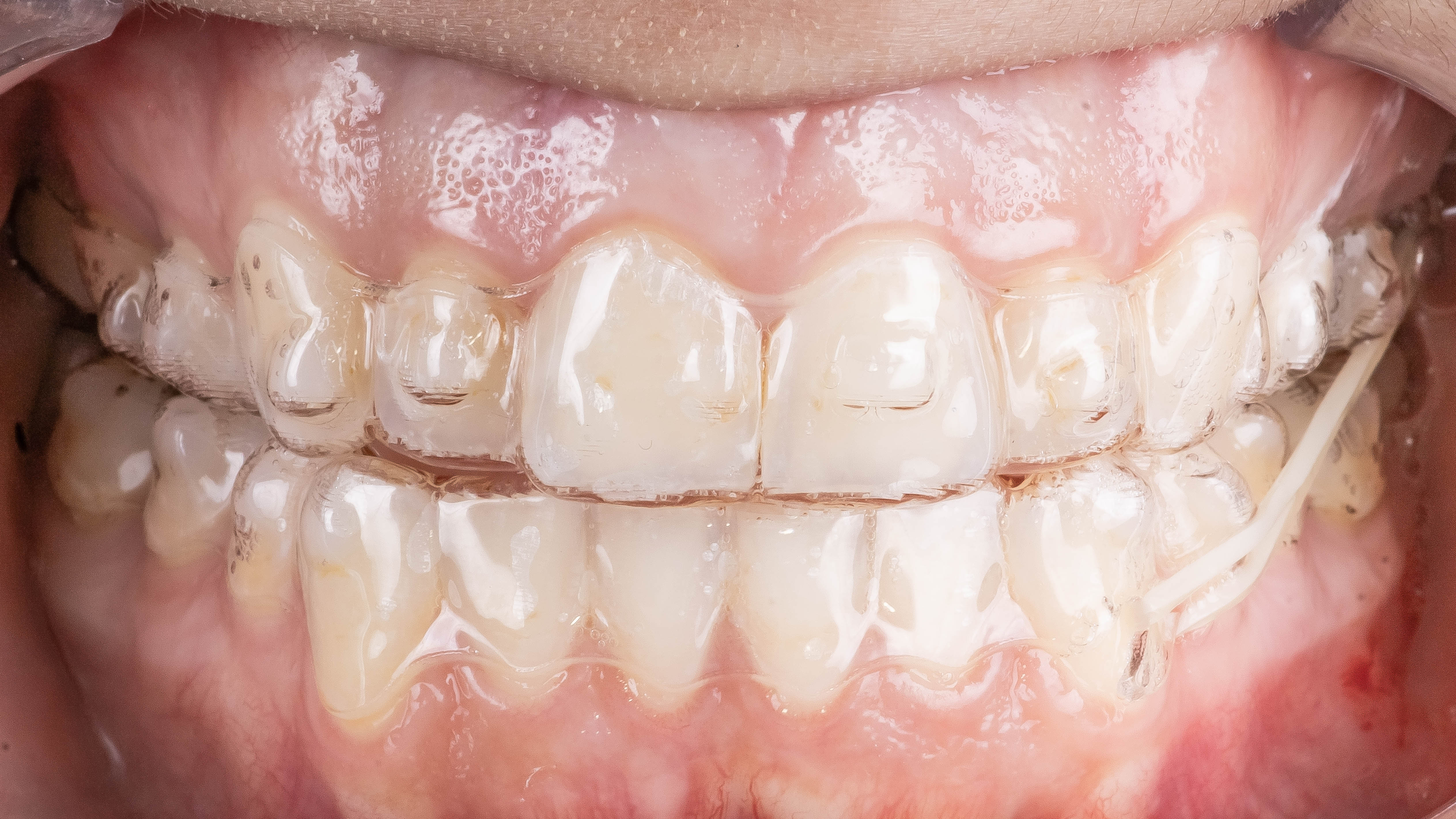 Invisalign em Botucatu na OdontoCentro
