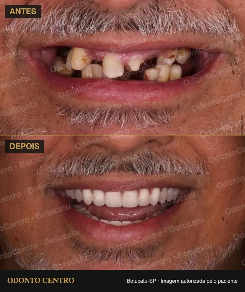 Antes e depois de prótese protocolo sobre implantes na OdontoCentro em Botucatu (caso real, imagem autorizada pelo paciente)