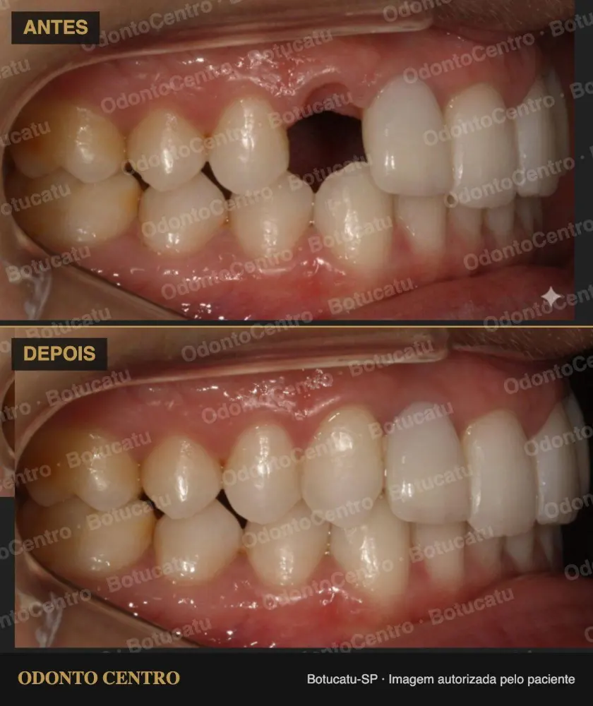 Antes e depois de coroas de porcelana na OdontoCentro em Botucatu (caso real, imagem autorizada pelo paciente)
