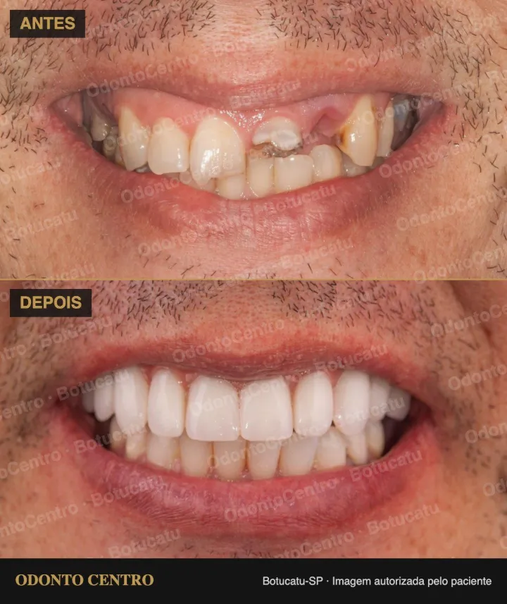 Antes e depois de prótese protocolo sobre implantes na OdontoCentro em Botucatu (caso real, imagem autorizada pelo paciente)