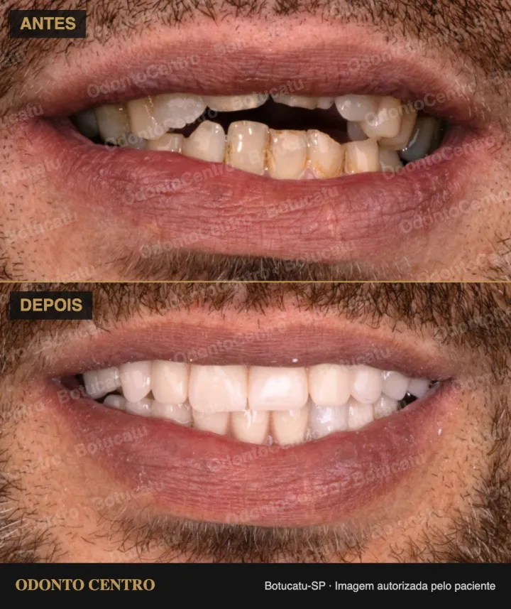 Antes e depois de prótese protocolo sobre implantes na OdontoCentro em Botucatu (caso real, imagem autorizada pelo paciente)