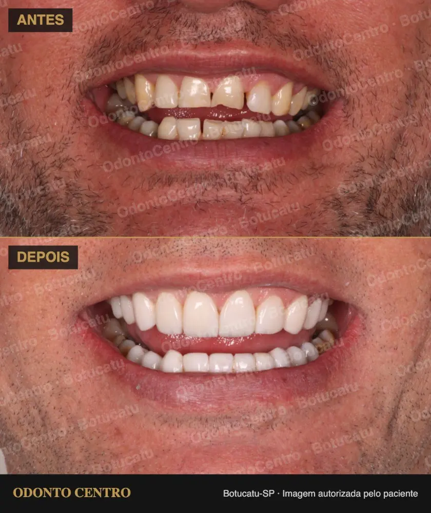 Antes e depois de lentes de resina na OdontoCentro em Botucatu (caso real, imagem autorizada pelo paciente)