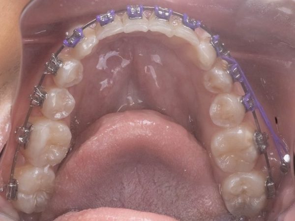 Arcada superior com aparelho ortodôntico, vista oclusal