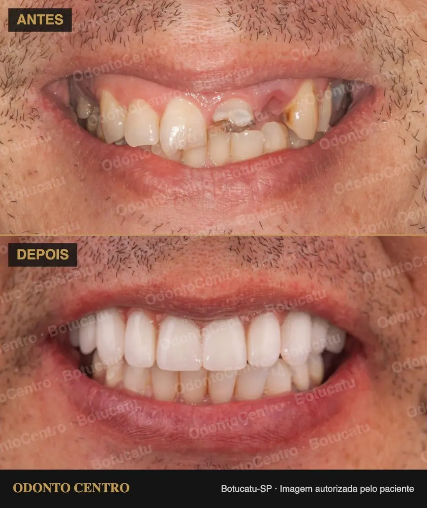 Antes e depois de prótese protocolo sobre implantes na OdontoCentro em Botucatu (caso real, imagem autorizada pelo paciente)