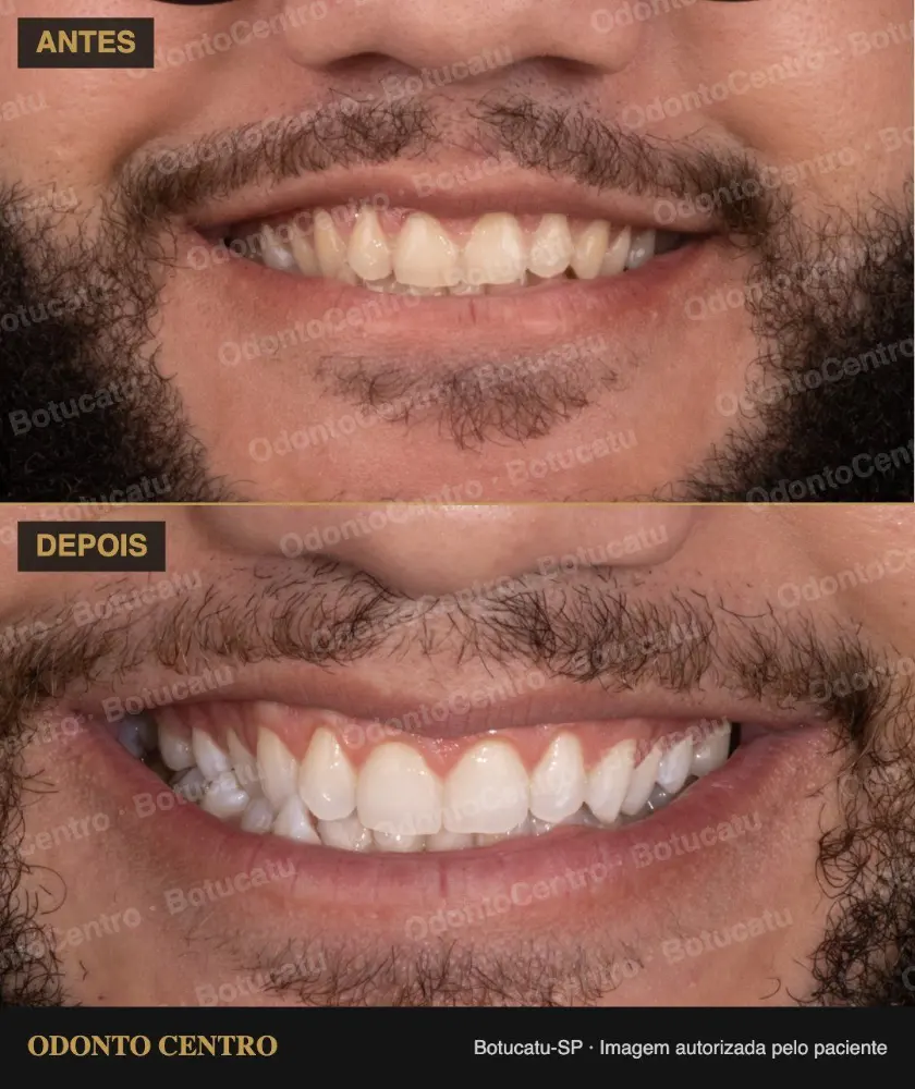 Antes e depois de clareamento dental na OdontoCentro em Botucatu (caso real, imagem autorizada pelo paciente)
