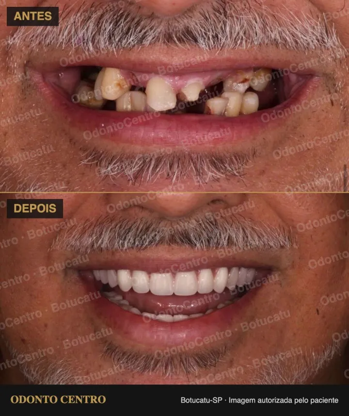 Antes e depois de prótese protocolo sobre implantes na OdontoCentro em Botucatu (caso real, imagem autorizada pelo paciente)