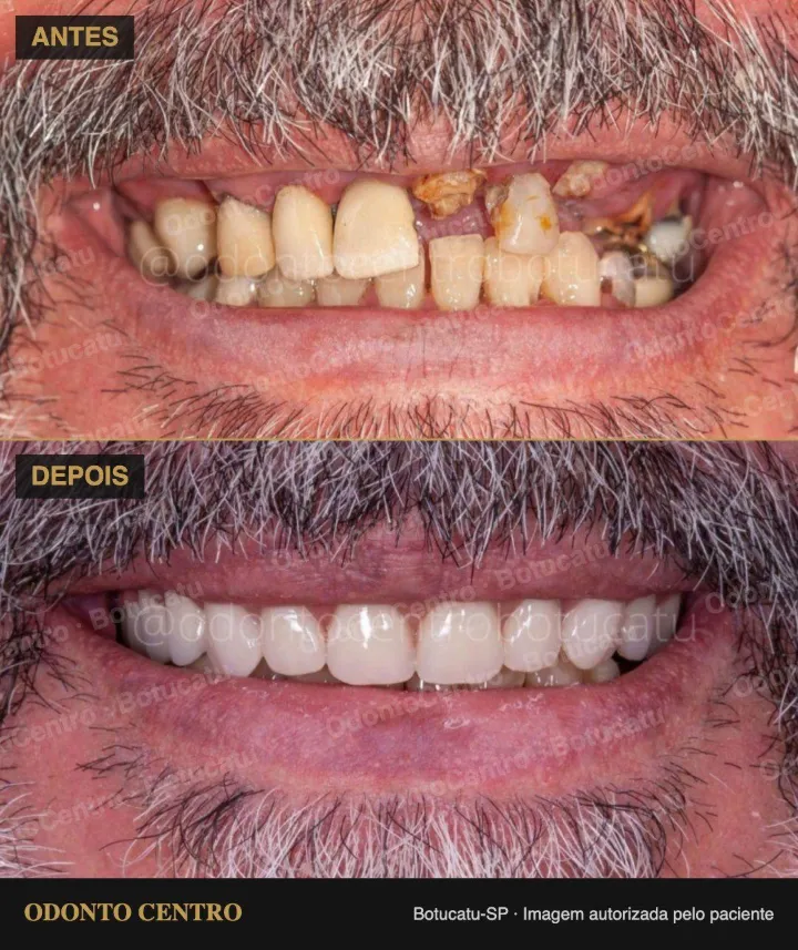 Antes e depois de prótese protocolo sobre implantes na OdontoCentro em Botucatu (caso real, imagem autorizada pelo paciente)