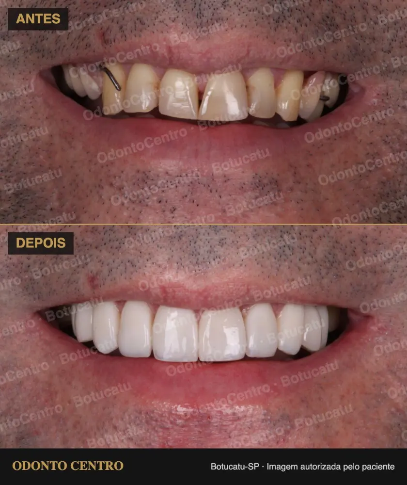 Antes e depois de lentes de resina na OdontoCentro em Botucatu (caso real, imagem autorizada pelo paciente)