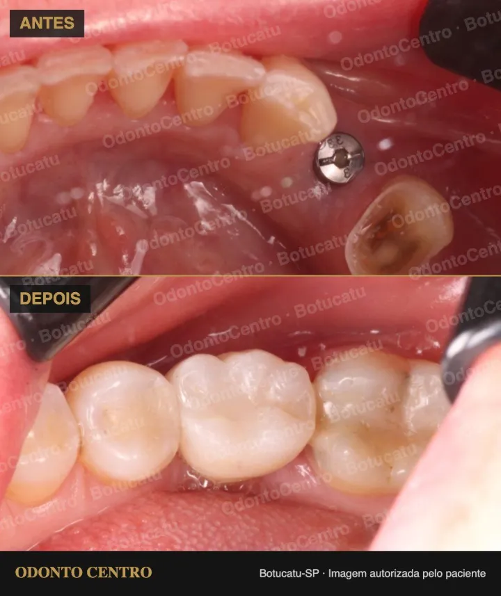 Antes e depois de coroa sobre implante na OdontoCentro em Botucatu (caso real, imagem autorizada pelo paciente)