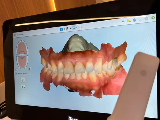 Tela do scanner iTero mostrando o planejamento digital 3D dos dentes