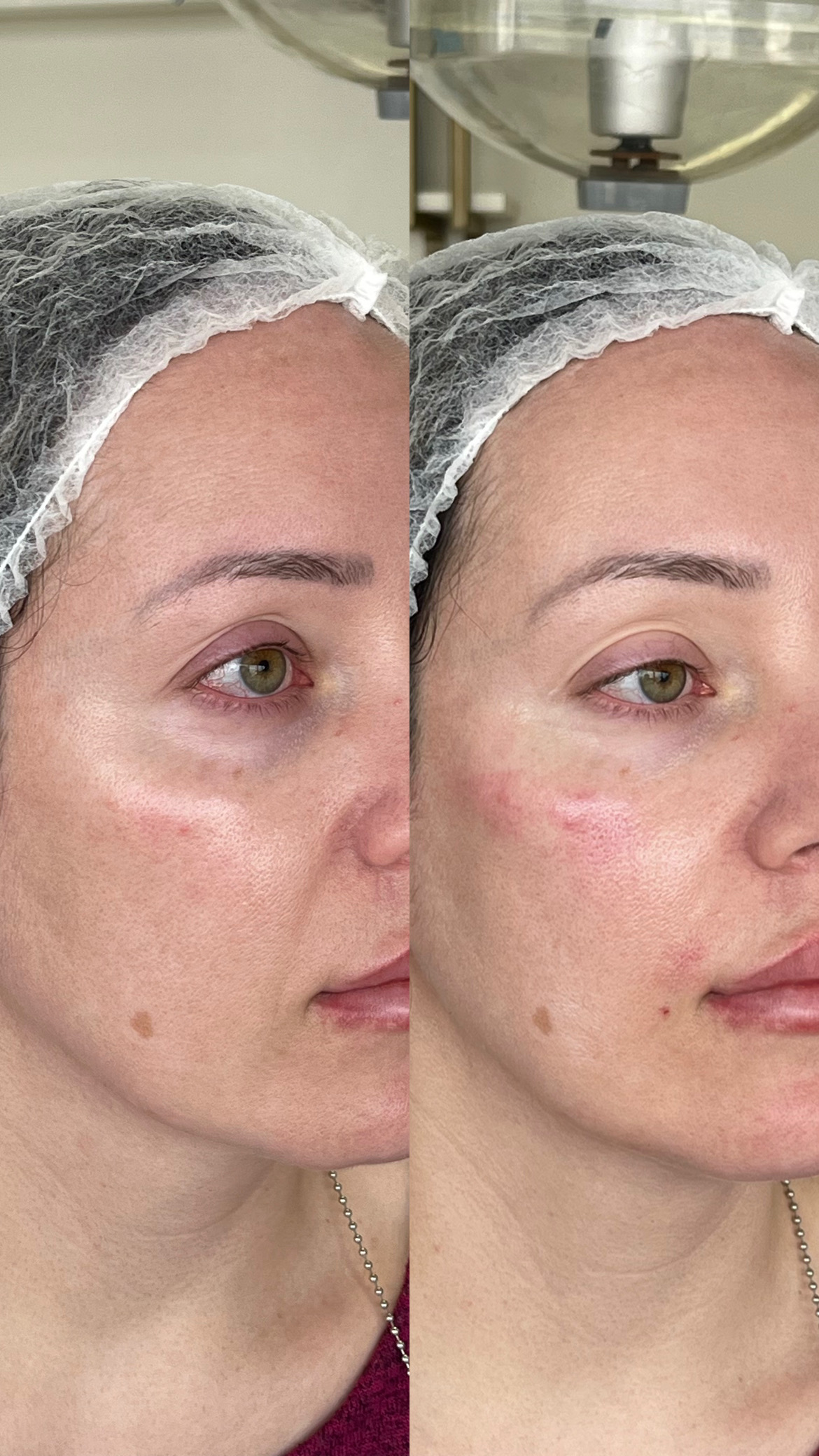 Antes do preenchimento facial