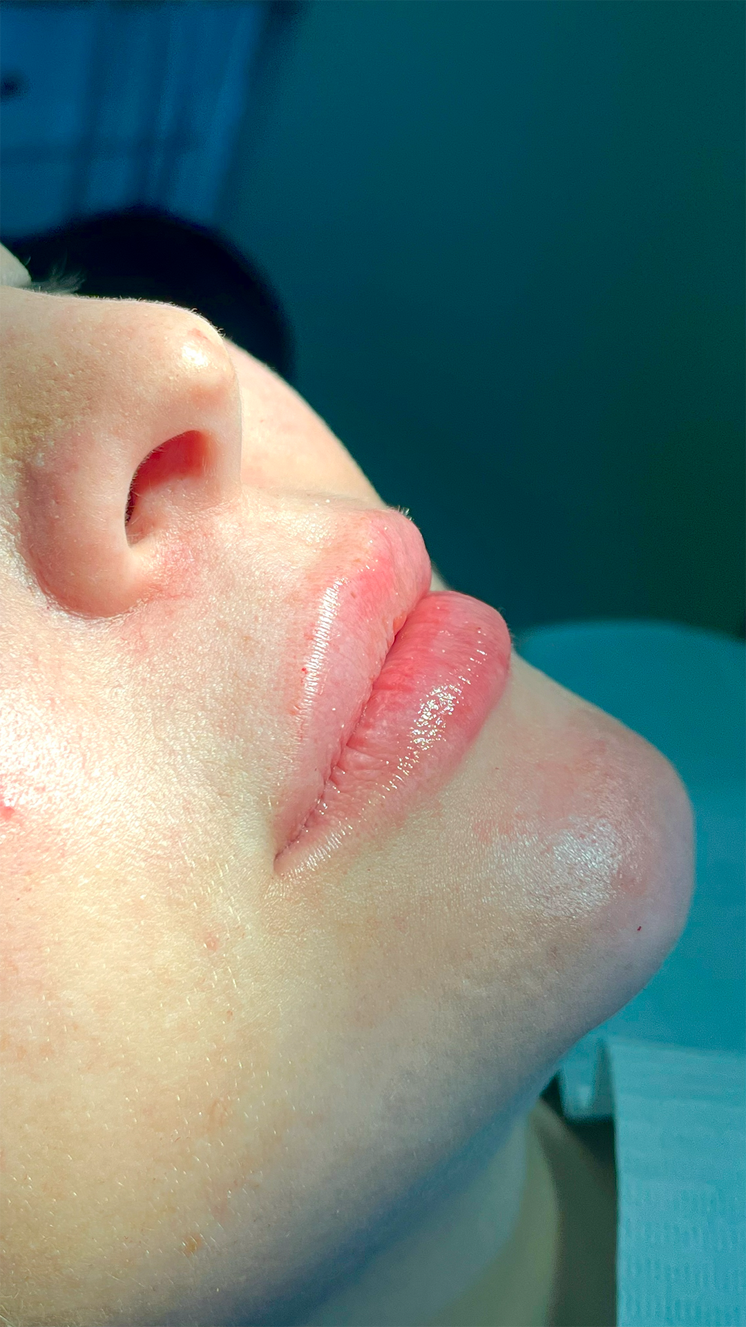 Antes do preenchimento labial