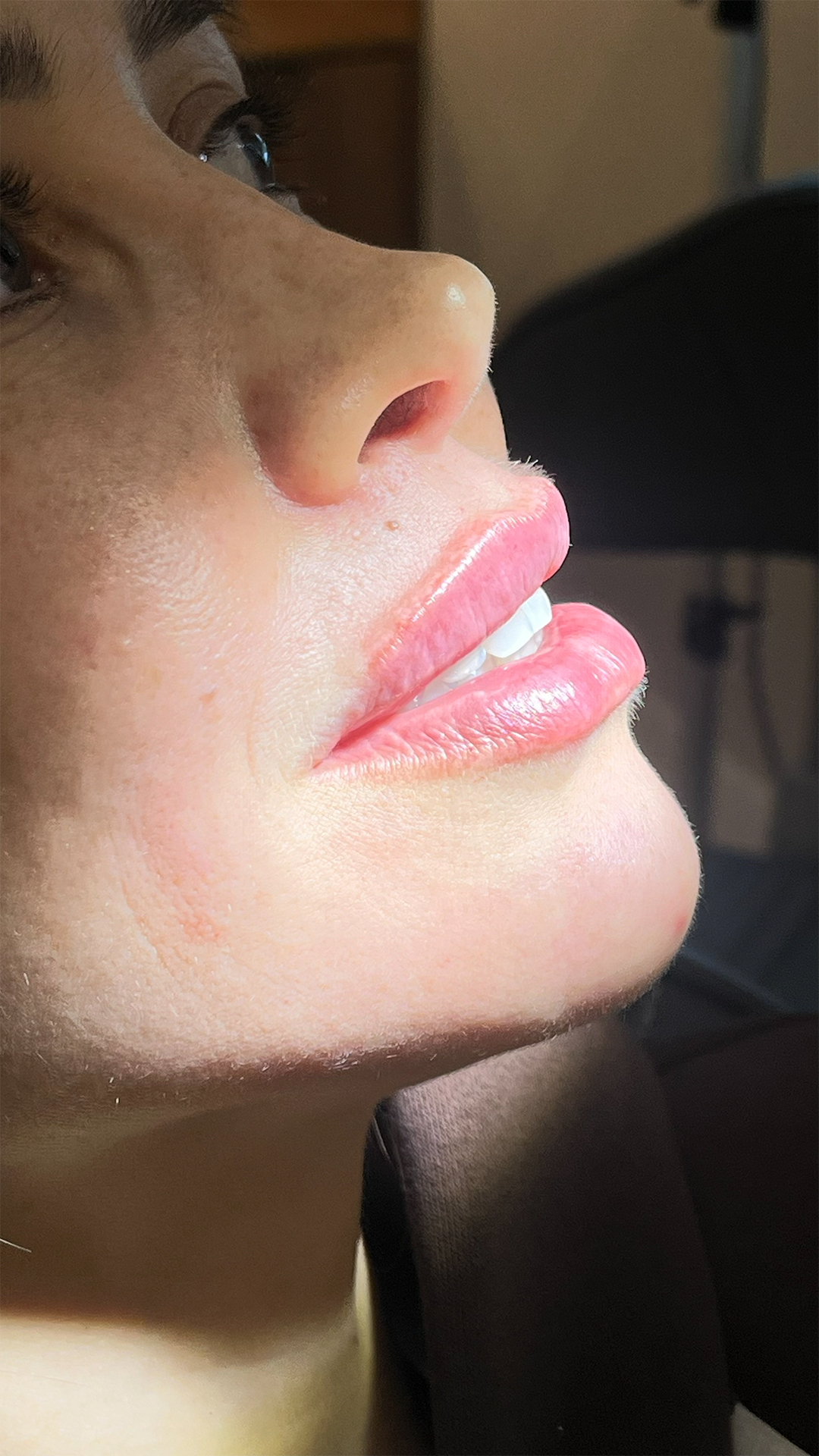 Depois do preenchimento labial