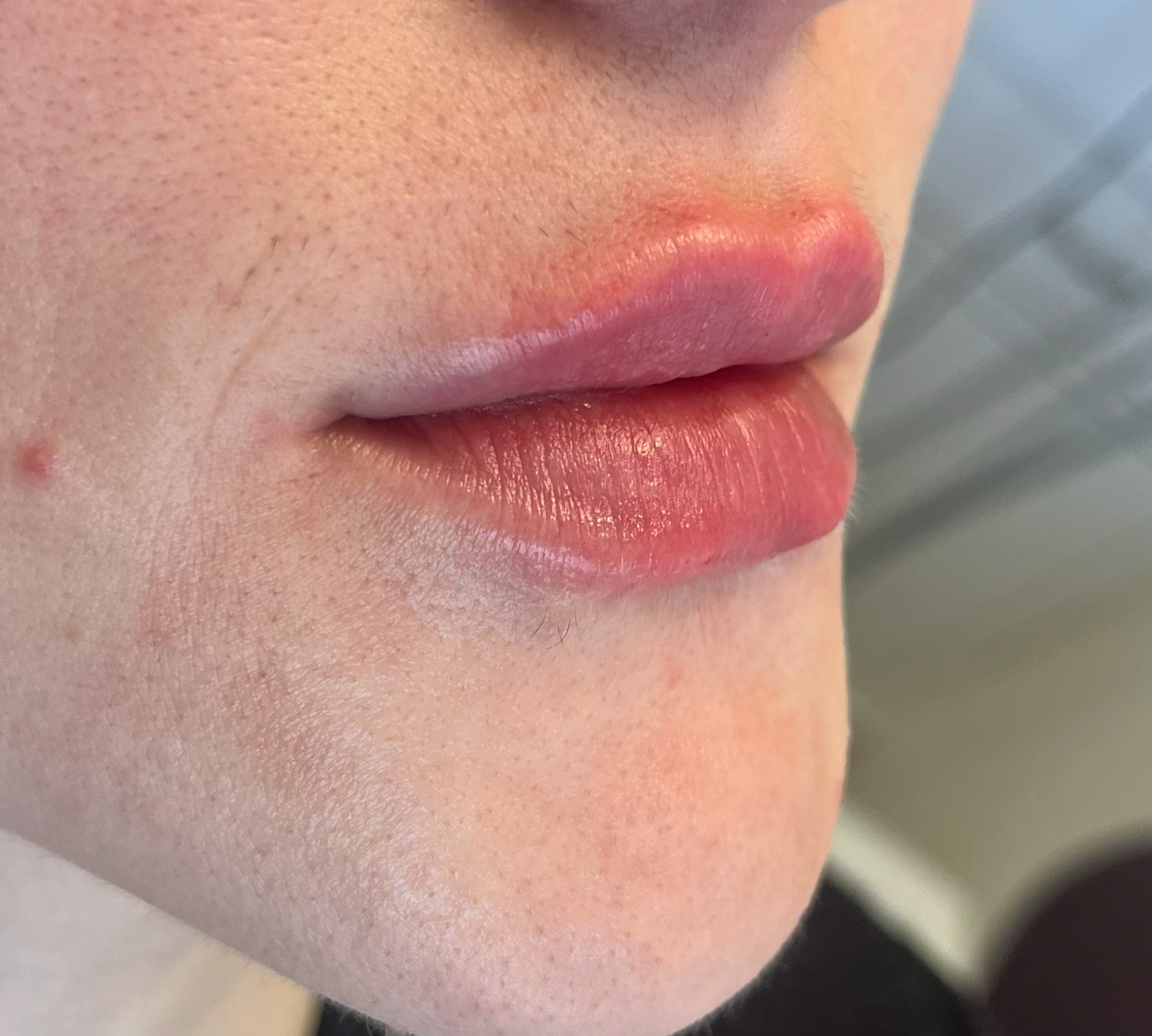 Antes do preenchimento labial